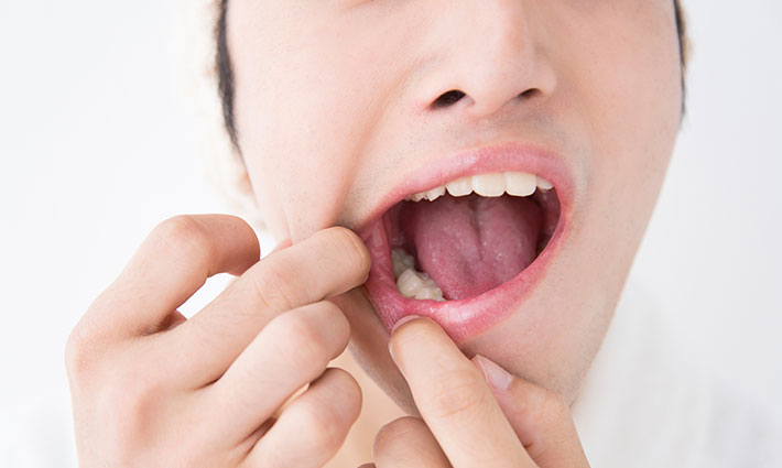 Mi segít az afták ellen? Tippek a megkönnyebbüléshez