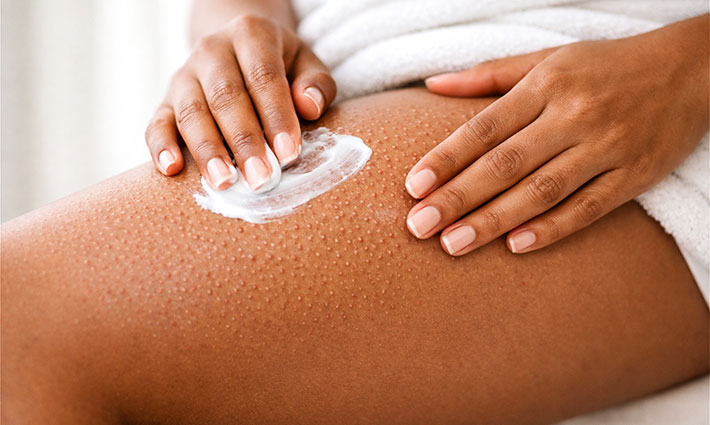 Keratosis pilaris – Mitől alakul ki, és hogyan kezelhető?